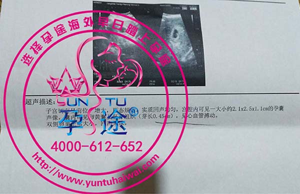 杰特宁医院泰国试管婴儿移植冻胚一次成功好孕！