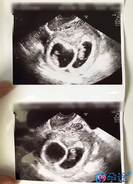 试管婴儿保胎多久才安全