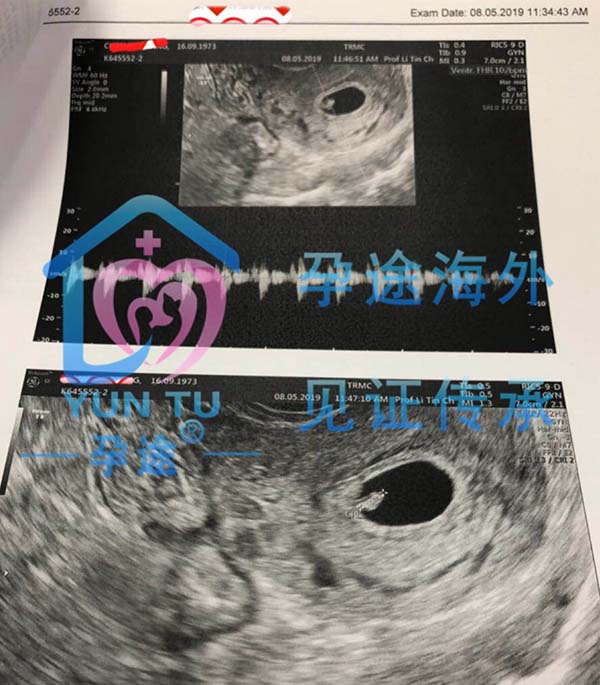 45岁L姐泰国试管婴儿+供卵自怀验孕成功!