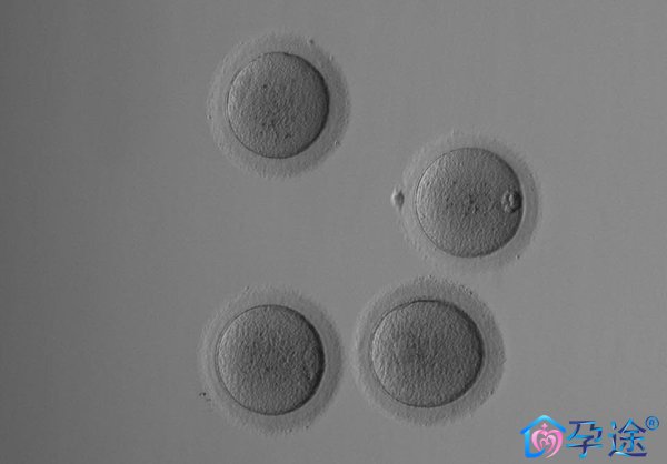 38高龄女泰国试管婴儿冻卵之路：冻卵流程及费用分享